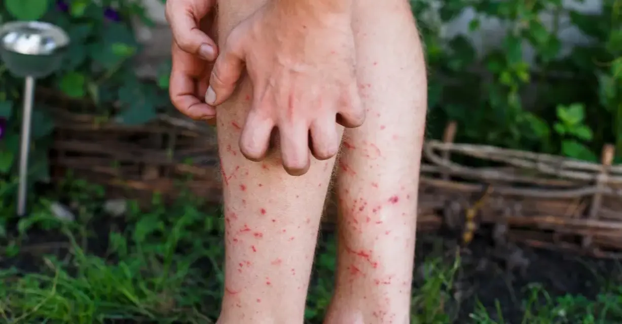 En person kliar sina ben som är täckta av röda prickar, troligen stress eksem.