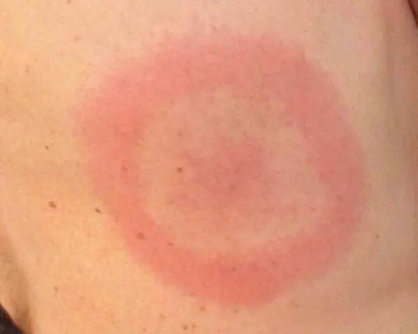 Rött, ringformat utslag på huden, liknande stressutslag på benen.