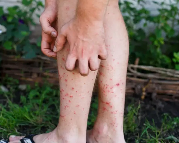 En person kliar sina ben som är täckta av röda prickar, troligen stress eksem.