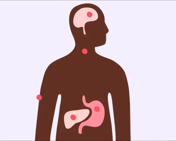 Illustration av en mänsklig silhuett med markerade organ som hjärna, hals, mage och lever. Röda prickar indikerar områden som kan påverkas, vilket väcker frågan: kan man få feber av stress?