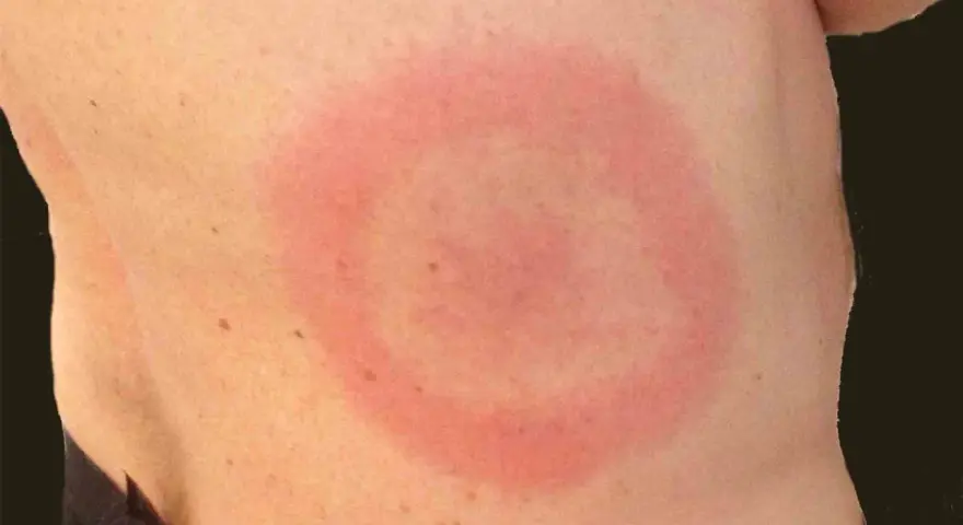 Rött, ringformat utslag på huden, liknande stressutslag på benen.