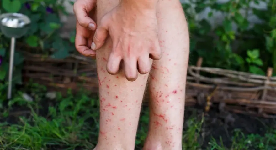 En person kliar sina ben som är täckta av röda prickar, troligen stress eksem.