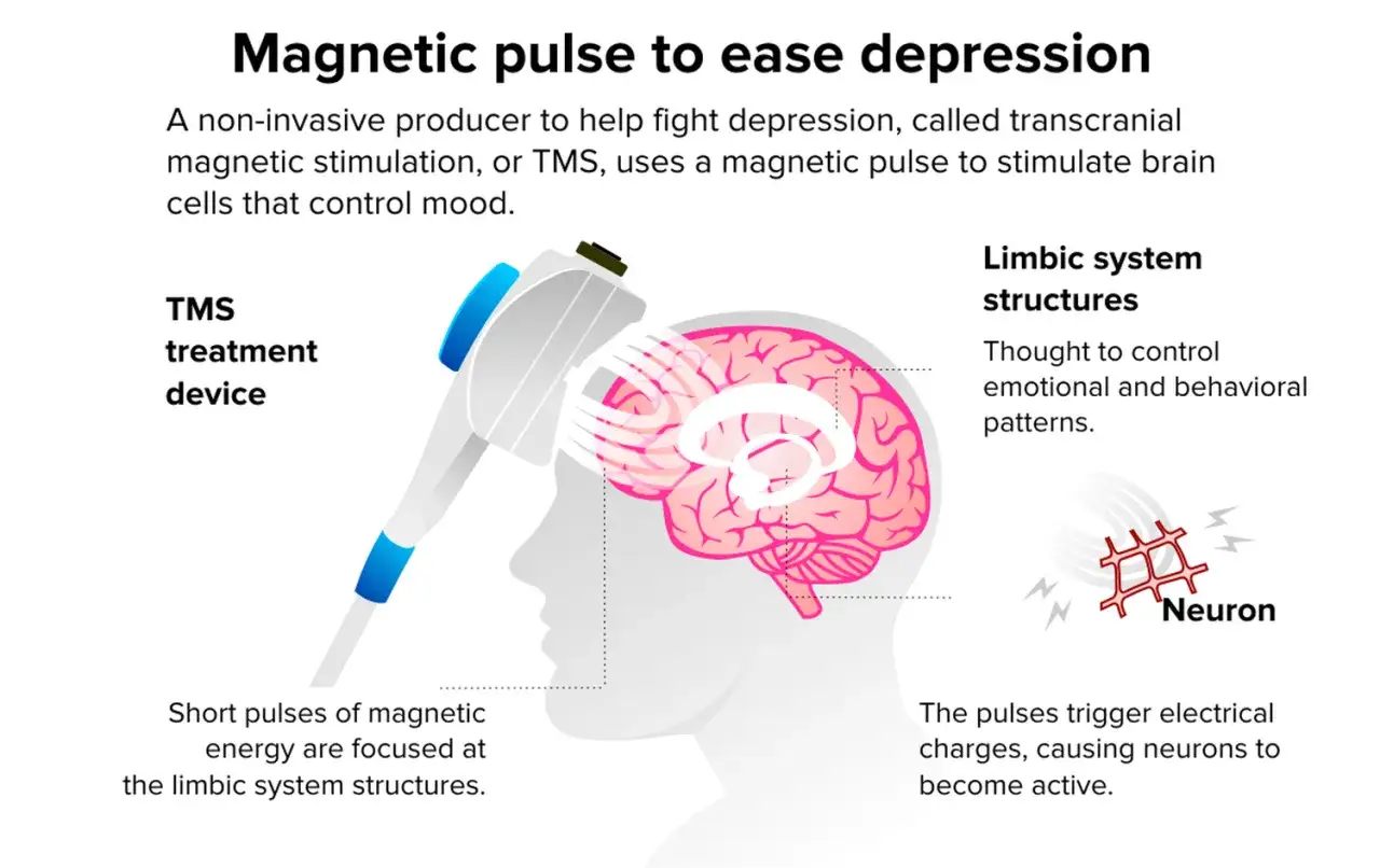 Illustration visar hur magnetbehandling, TMS, anv&auml;nds f&ouml;r att stimulera hj&auml;rnan och lindra depression.